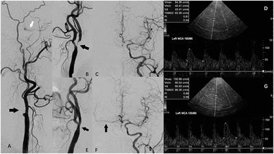 Hemodynamic Surveillance of Unilateral Carotid Artery Stenting in Patients With or Without Contralateral Carotid Occlusion by TCD/TCCD in the Early Stage Following Procedure